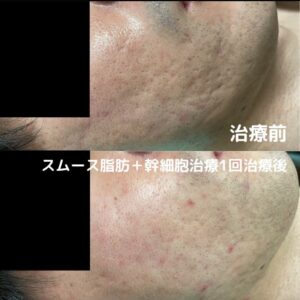 最新ニキビ跡治療 皮膚再生 幹細胞治療 東京銀座クリニック